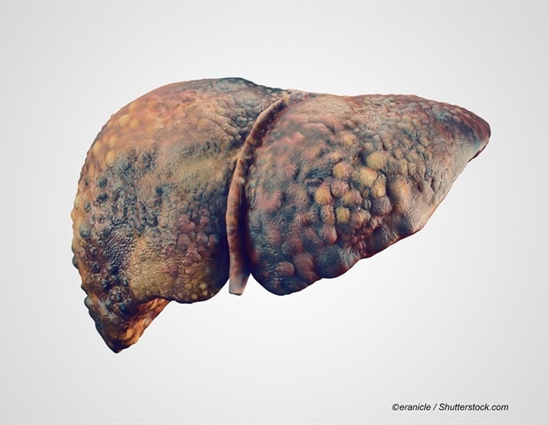 Shared gene signatures reveal metabolic dysfunction in liver cirrhosis and acute-on-chronic liver failure Shared gene signatures reveal metabolic dysfunction in liver cirrhosis and acute-on-chronic liver failure
