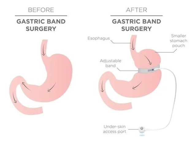 Study finds surge in the use of weight loss drugs among bariatric surgery patients Study finds surge in the use of weight loss drugs among bariatric surgery patients
